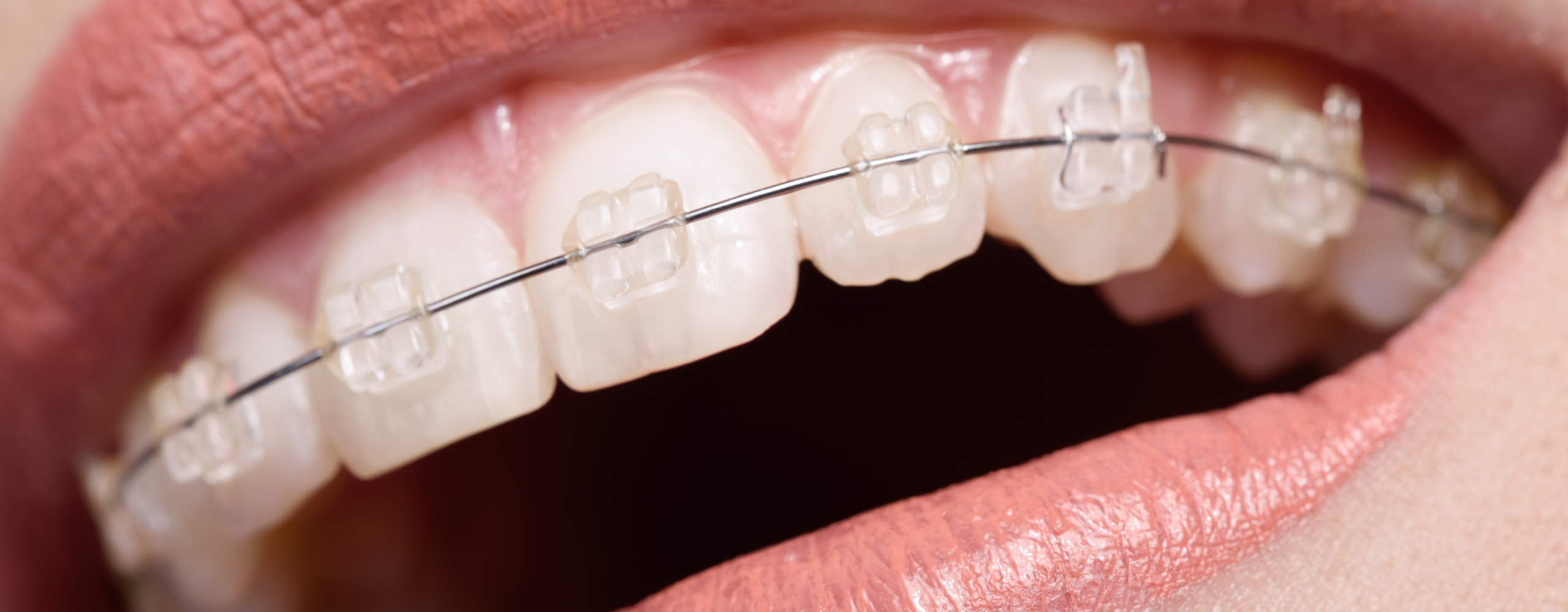 Niềng Răng Mắc Cài Sứ – Chỉnh Nha Thẩm Mỹ Kín Đáo