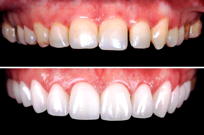 Trám Răng Thẩm Mỹ