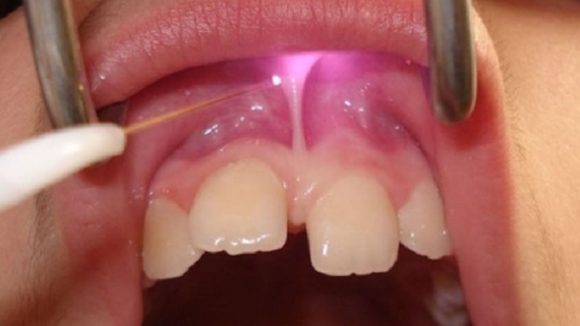 Cắt Phanh Môi / Lưỡi