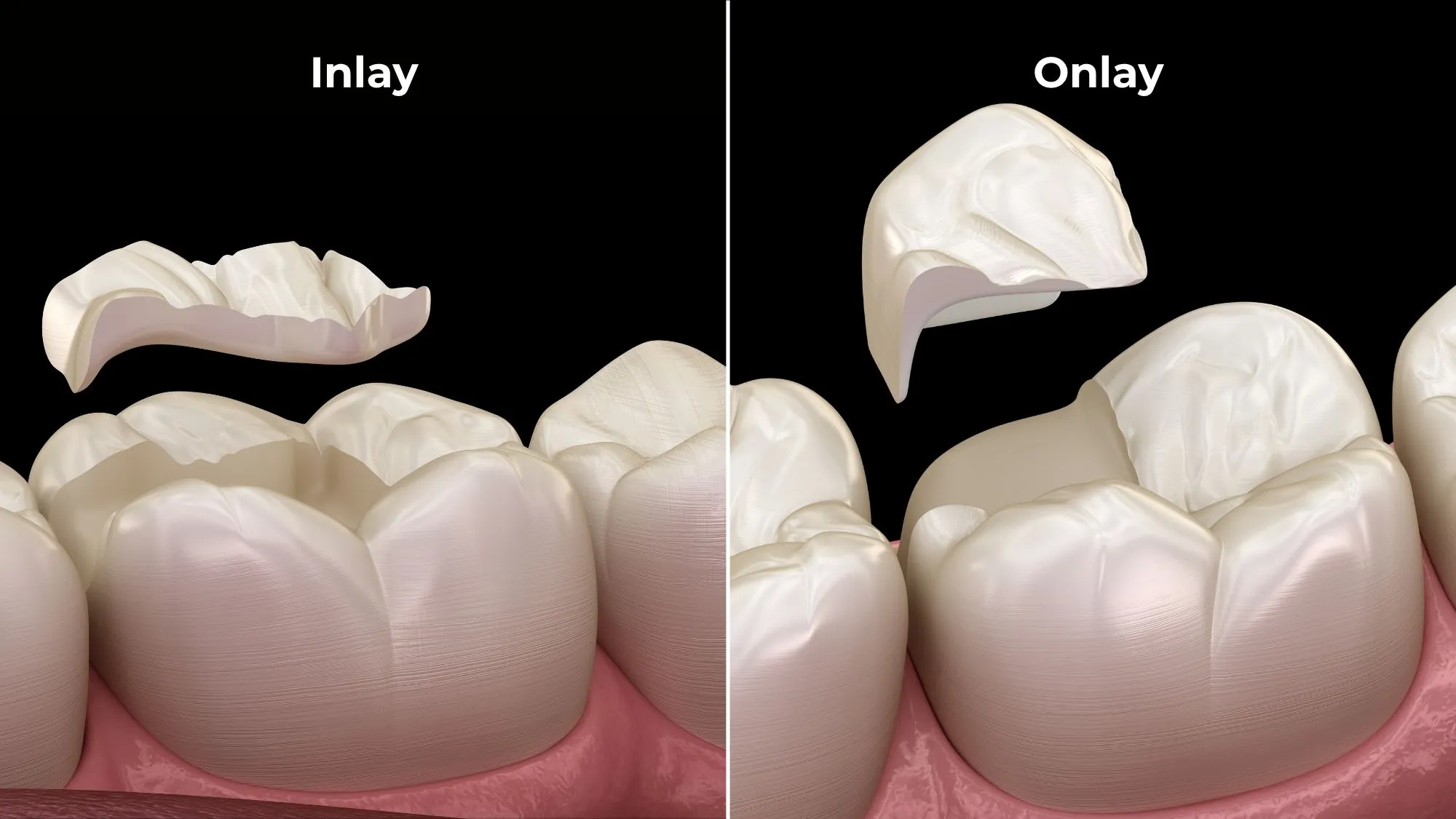 Miếng Trám Sứ Inlay & Onlay