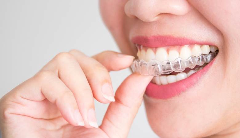 Niềng Răng Invisalign – Chỉnh Nha Trong Suốt Công Nghệ Cao