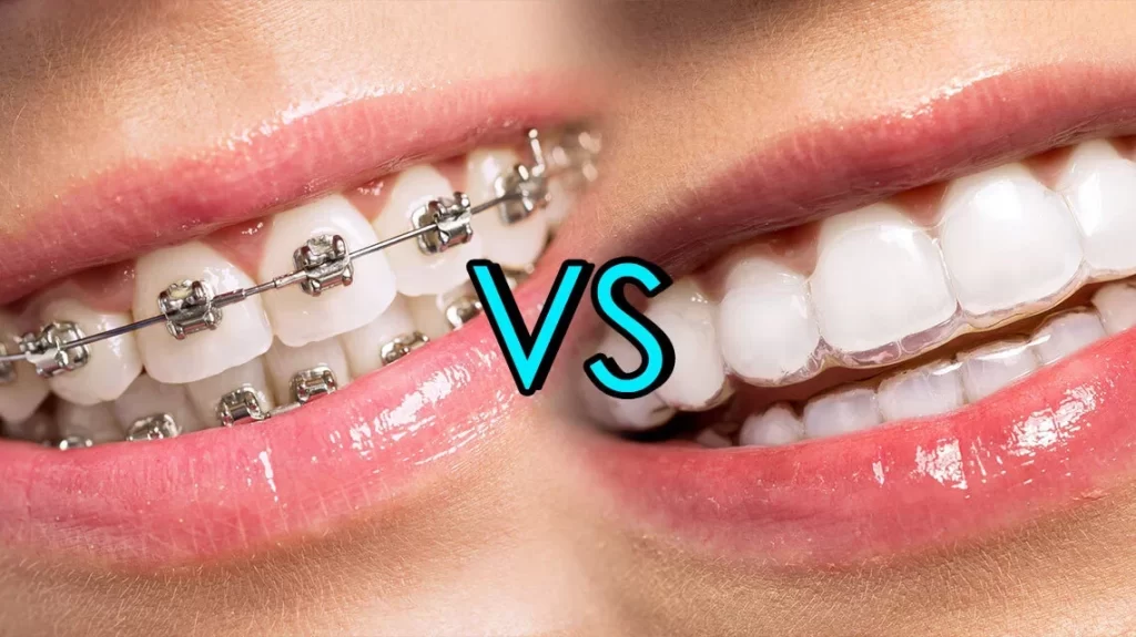 Invisalign vs niềng răng
