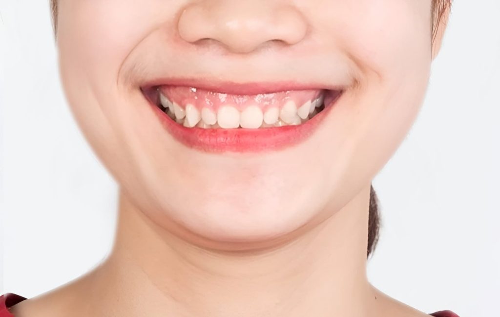 Niềng răng có cải thiện cười hở lợi